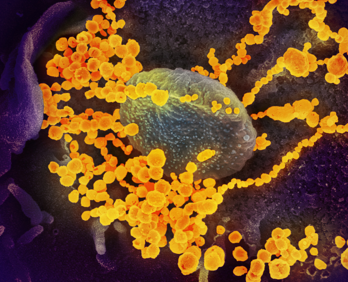 SAR-CoVID-2 (yellow) emerging from human cells